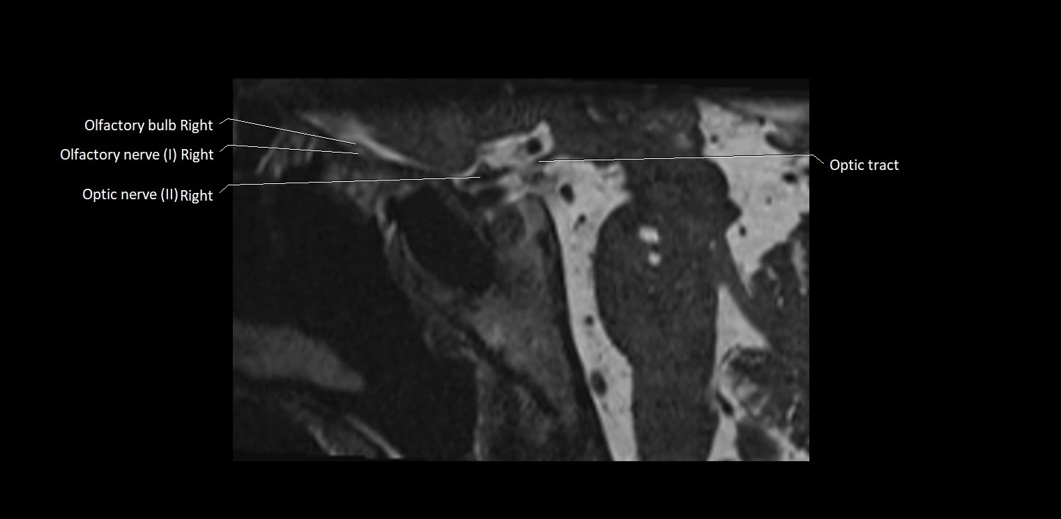 Cranial nerve sagittal anatomy MRI 3T image 35.webp